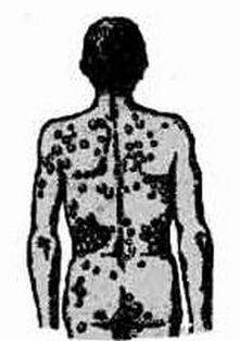 The intention of potential infection