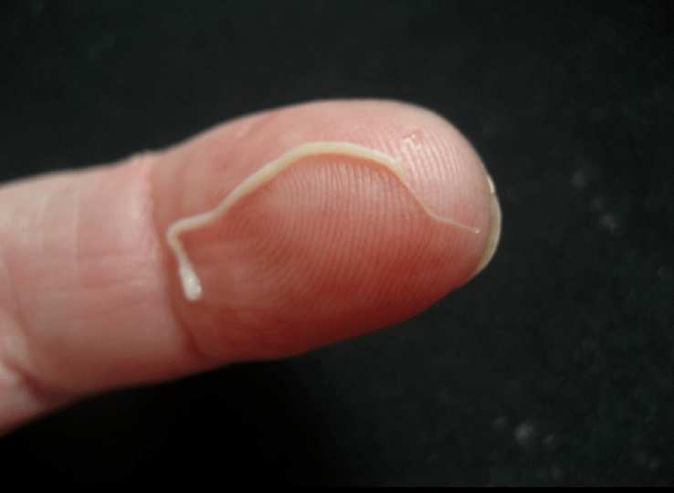 roundworm parasites of the human body